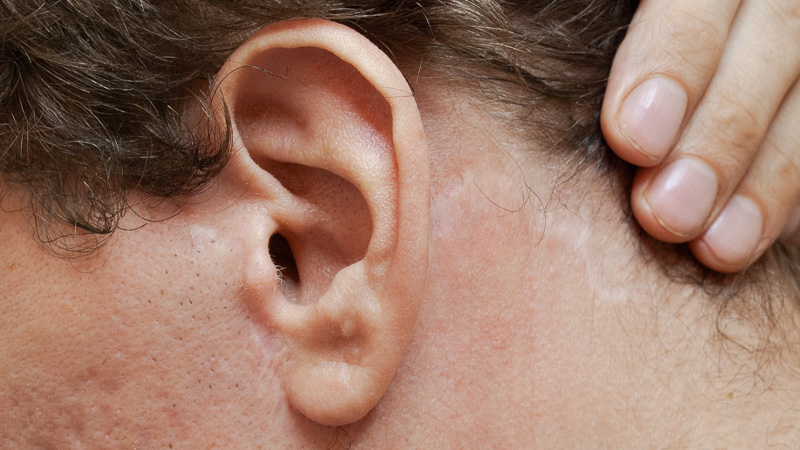 Narbenpigmentierung Beispiel nachher