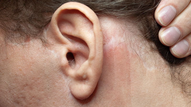 Narbenpigmentierung Beispiel vorher